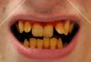 http://i1270.photobucket.com/albums/jj601/infoman21/stock-photo-11874000-yellow-teeth.jpg